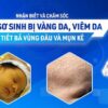 Nhận biết và chăm sóc trẻ sơ sinh bị vàng da, viêm da tiết bã vùng đầu và mụn kê