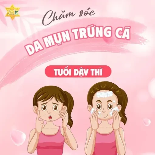 Chăm sóc da mụn trứng cá tuổi dậy thì