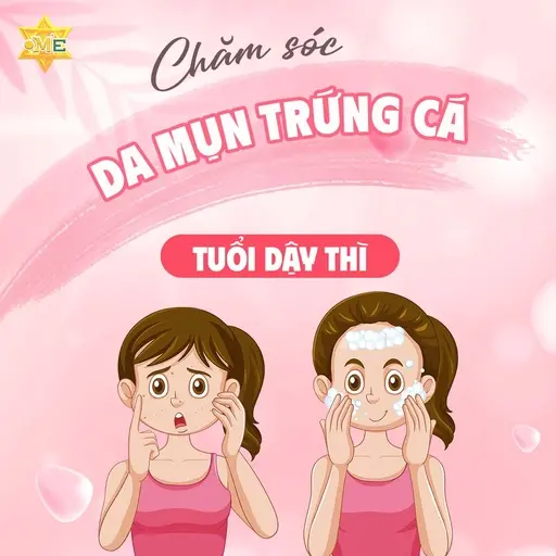 Chăm sóc da mụn trứng cá tuổi dậy thì Chăm sóc da mụn trứng cá tuổi dậy thì